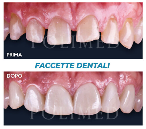 faccette-dentali_1_centropolimed
