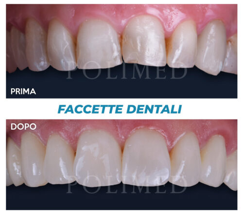 faccette-dentali_2_centropolimed