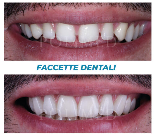 faccette-dentali_3_centropolimed