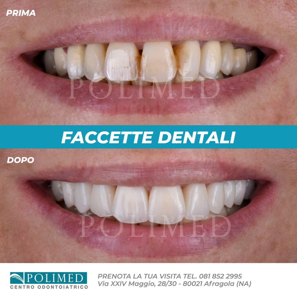 faccette dentali prima e dopo