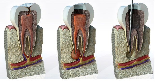 devitalizzazione dente