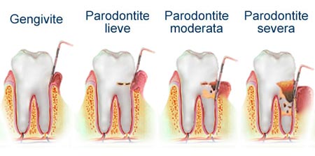parodontite