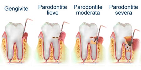 paradontite e gengivite