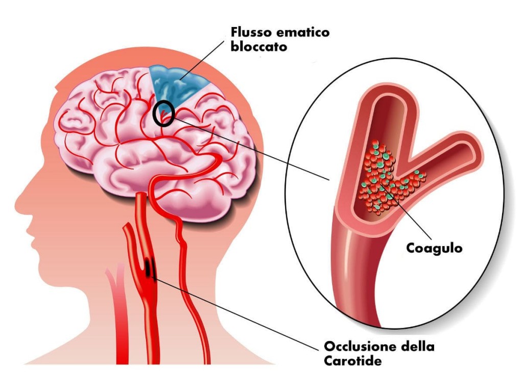 ictus cerebrale