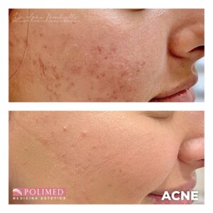 cura acne