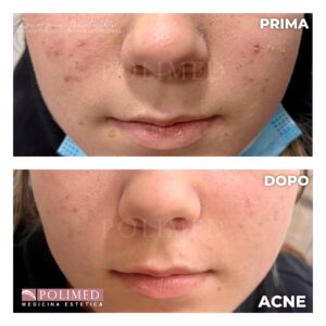 cura acne