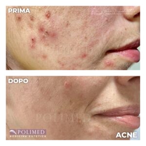 cura acne