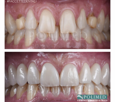 Faccette dentali estetiche: il risultato ottenuto da un nostro paziente